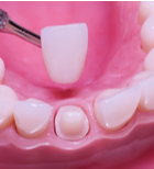 כתרי זירקוניה: מהפכה אסתטית ובריאותית -תמונה